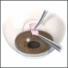 Glaucoma Shunt